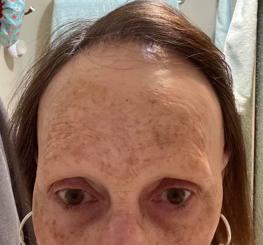 Receding Hairline Tammy Lobato Hair Replacement Services