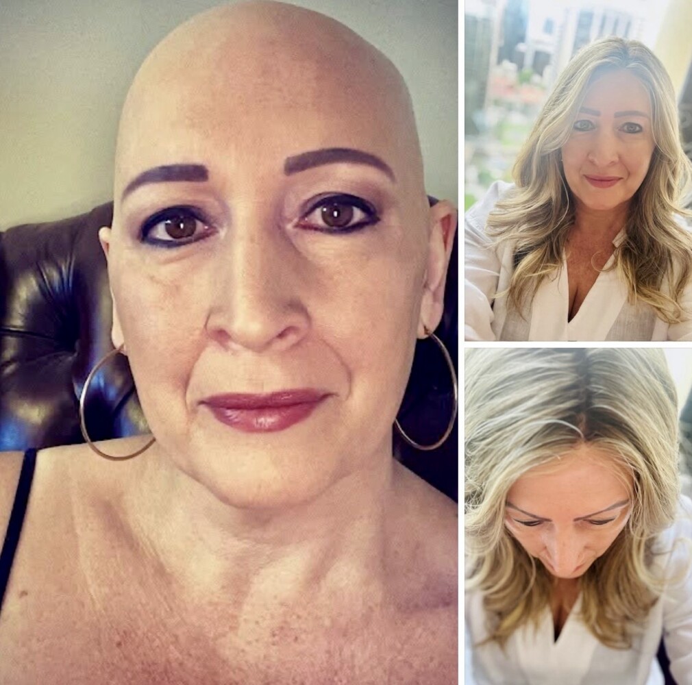 Hair loss - debilitating, depressing and isolating