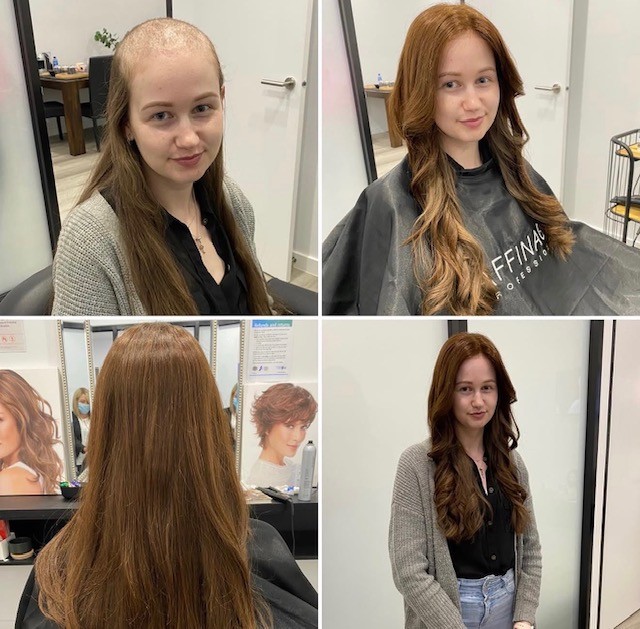 Trichotillomania: Understanding the Compulsion and Finding Ways Forward