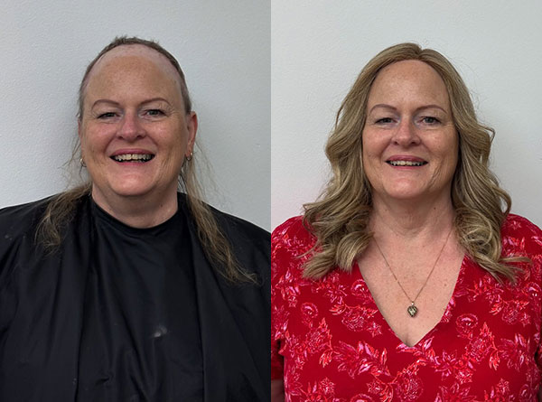 Hair Solutions for Alopecia & Auto-Immune Conditions