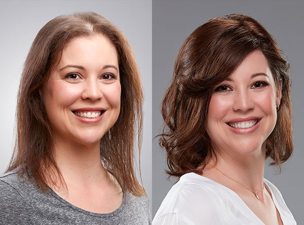 Personalised Support for Thinning & Receding Hair