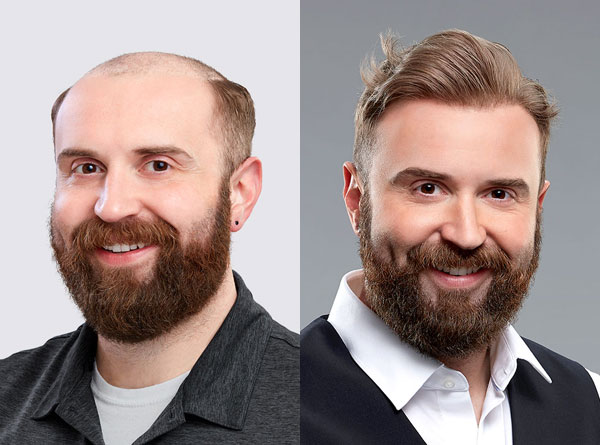 Understanding Men's Hair Loss