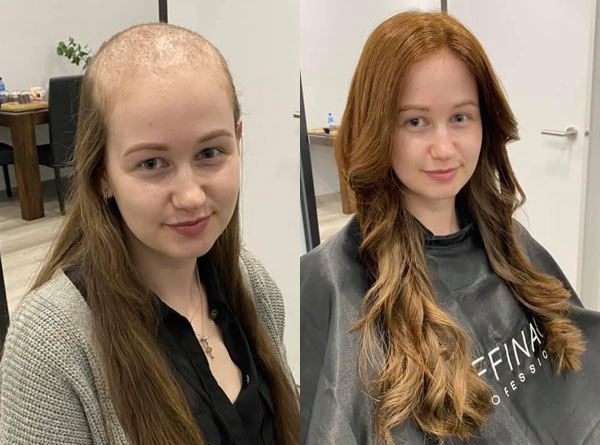 Understanding Trichotillomania