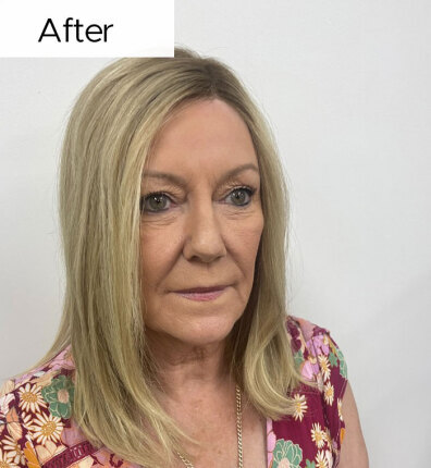 Tracey after bonded topper