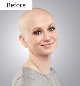 Alopecia Client Services