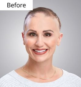 Alopecia Client Services